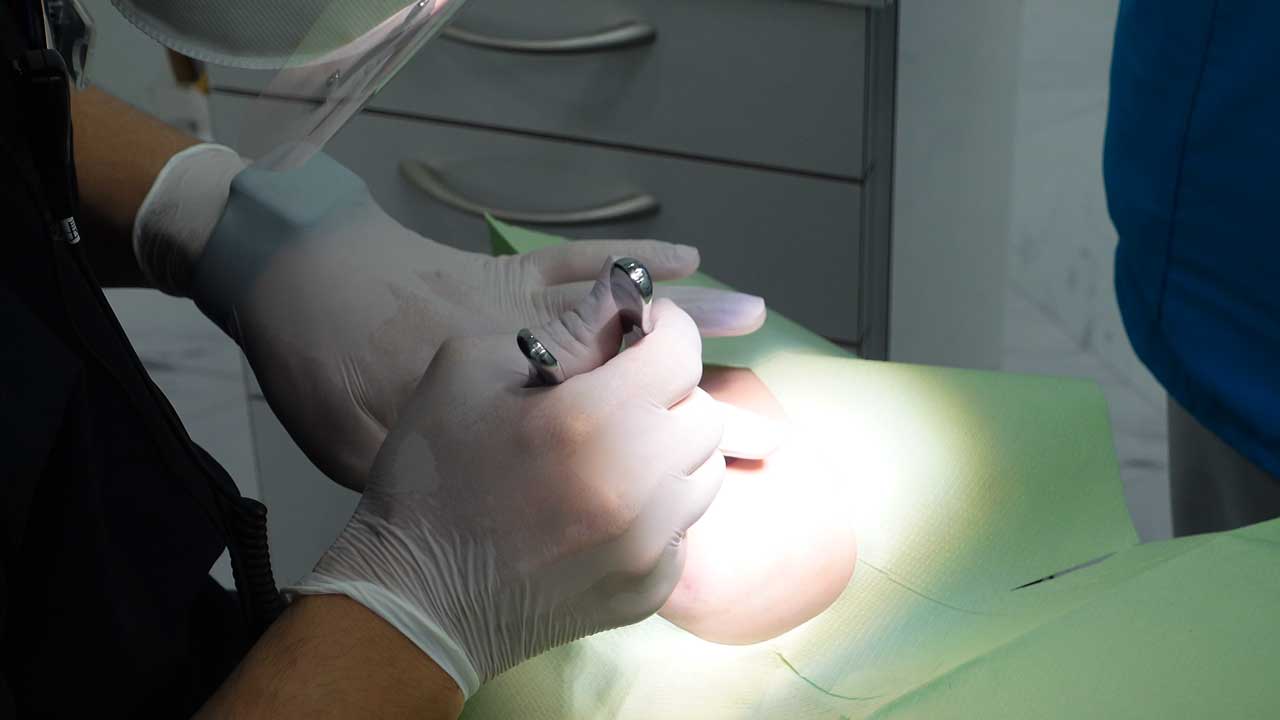 親知らず抜歯の様子